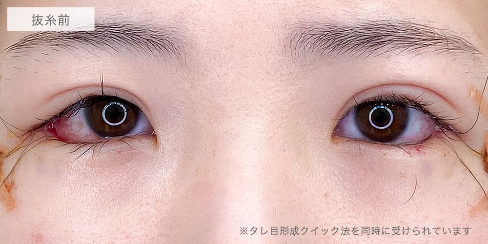 目尻切開症例写真5