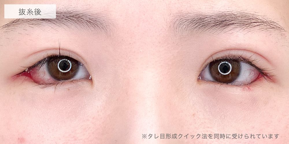 目尻切開症例写真6