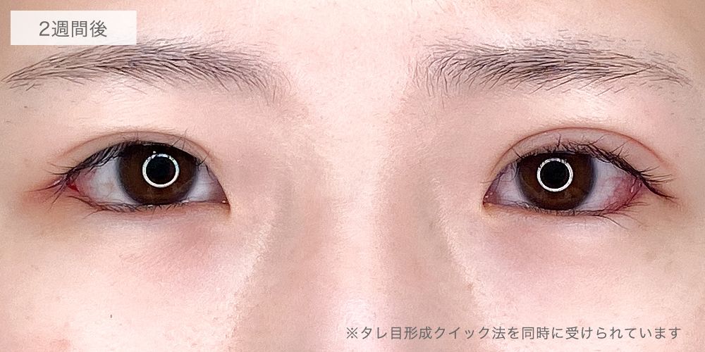 目尻切開症例写真7