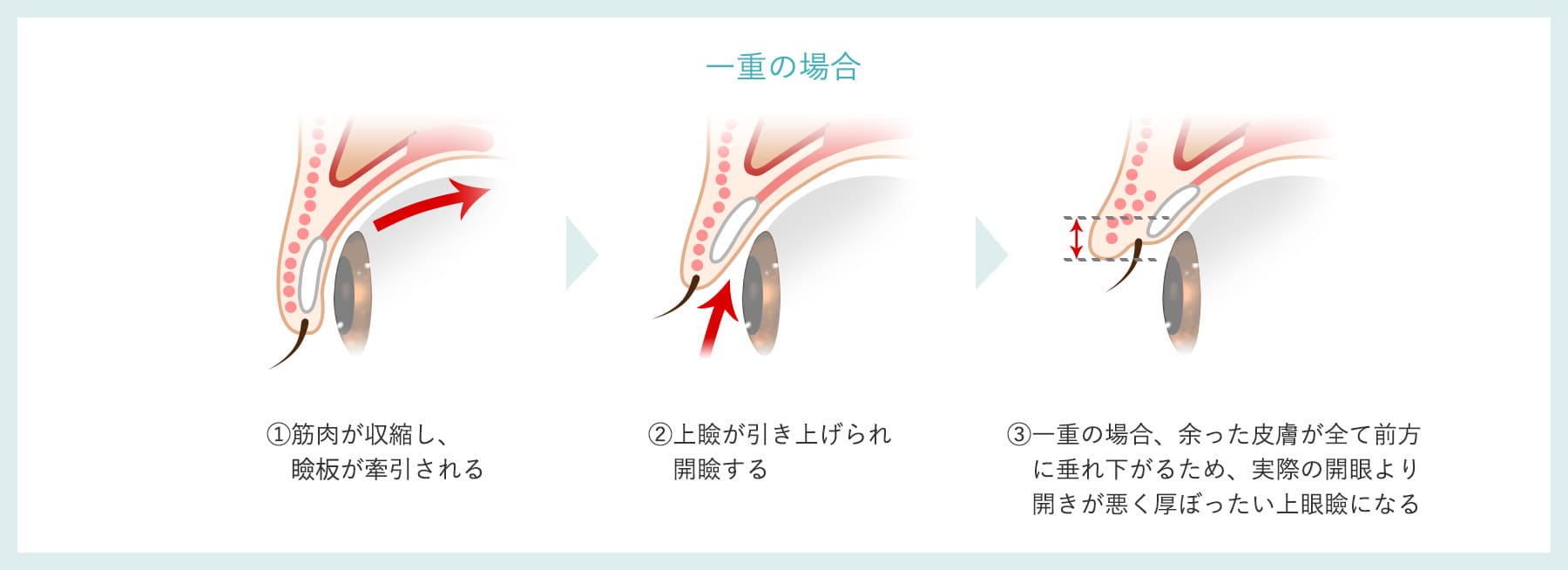 まぶたの構造
