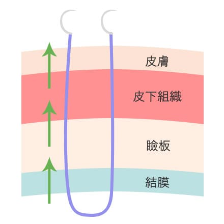 二重まぶたの形成方法①
