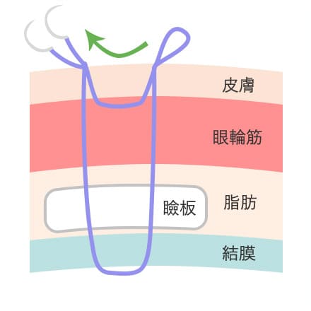 二重まぶたの形成方法②
