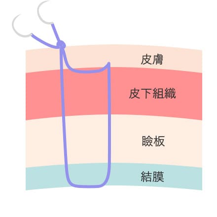 二重まぶたの形成方法③
