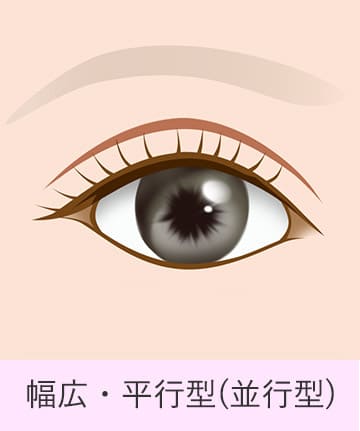 二重の種類