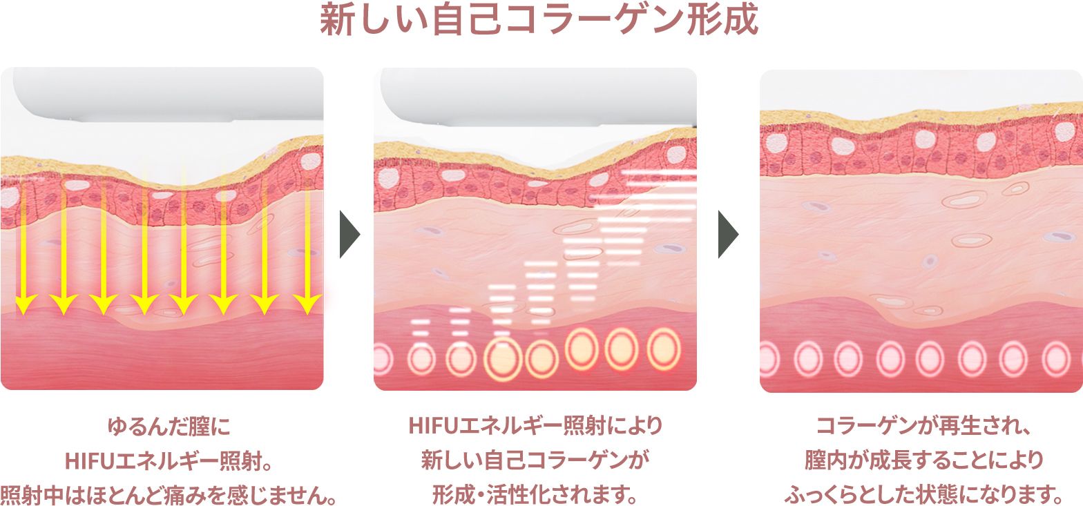 ウルトラヴェラ(膣HIFU)について