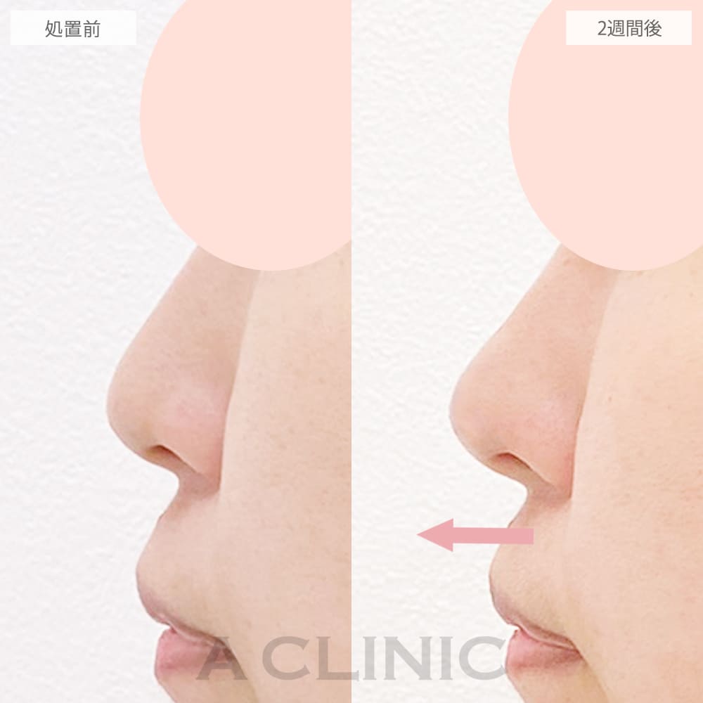 鼻尖形成(耳介軟骨・耳珠軟骨移植)の症例写真2