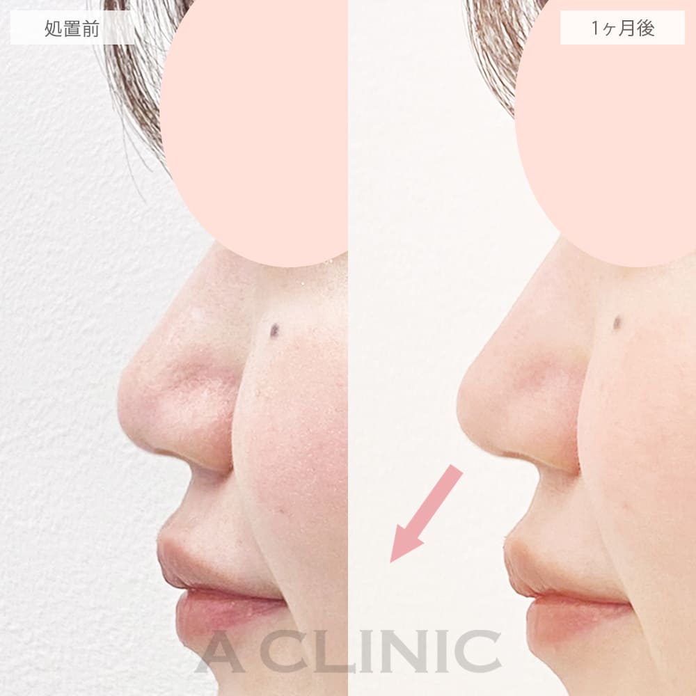 鼻尖形成(耳介軟骨・耳珠軟骨移植)の症例写真3