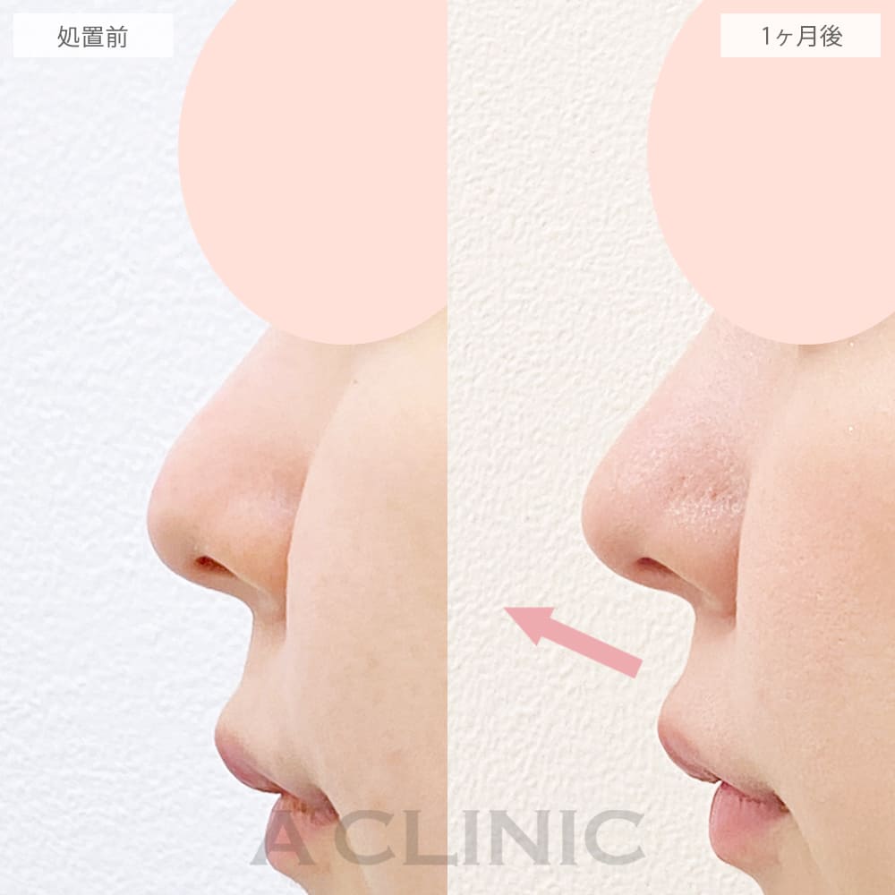 鼻尖形成(耳介軟骨・耳珠軟骨移植)の症例写真4
