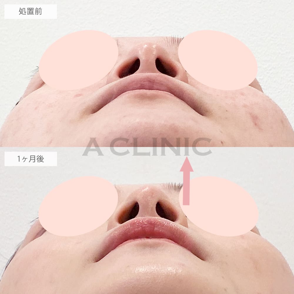 鼻尖形成(耳介軟骨・耳珠軟骨移植)の症例写真5