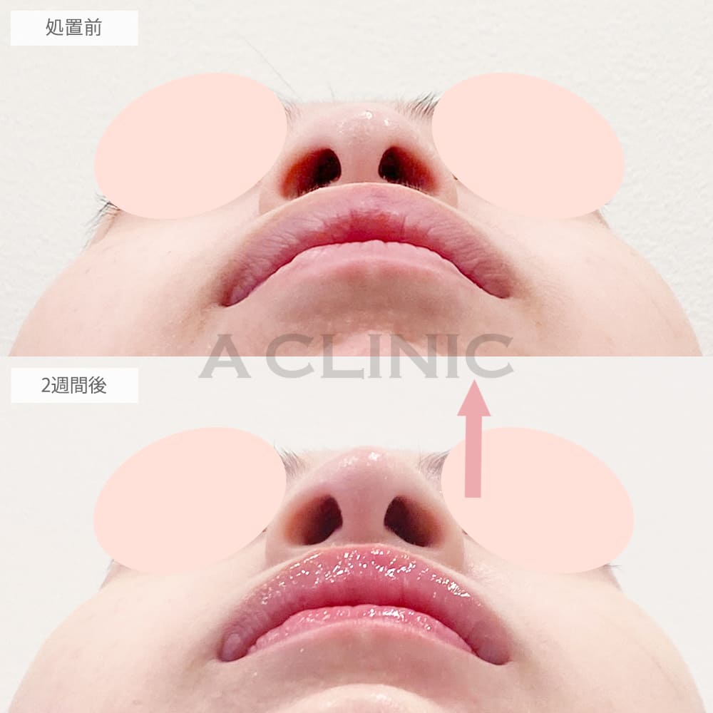 鼻尖形成(耳介軟骨・耳珠軟骨移植)の症例写真6