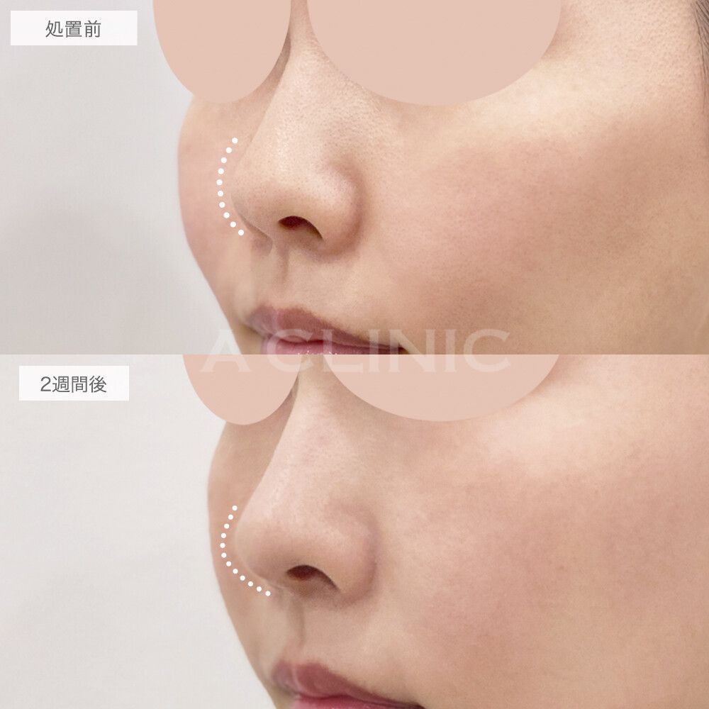鼻尖形成(耳介軟骨・耳珠軟骨移植)の症例写真7