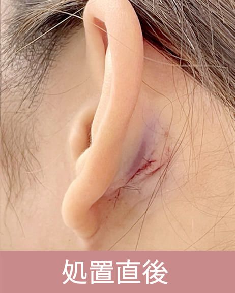 耳介軟骨移植の経過2