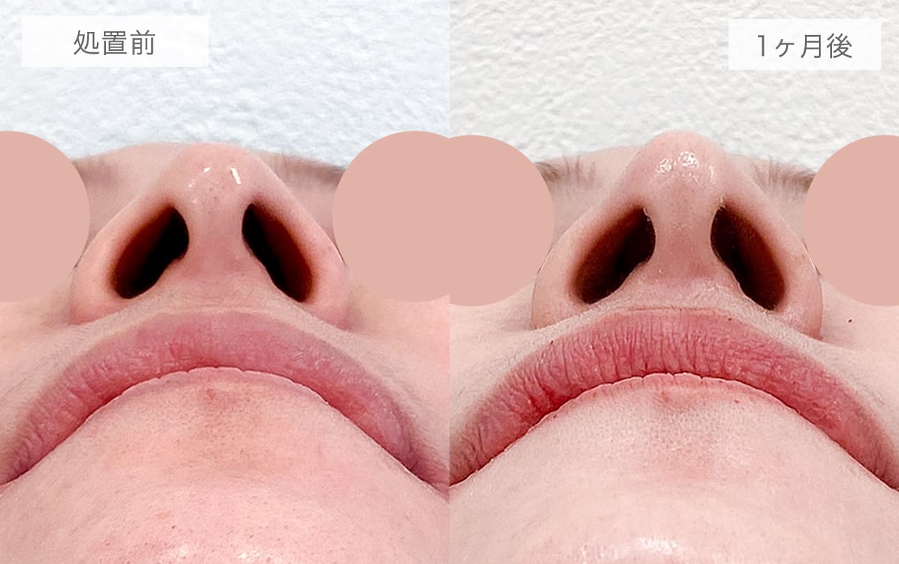 耳介軟骨移植