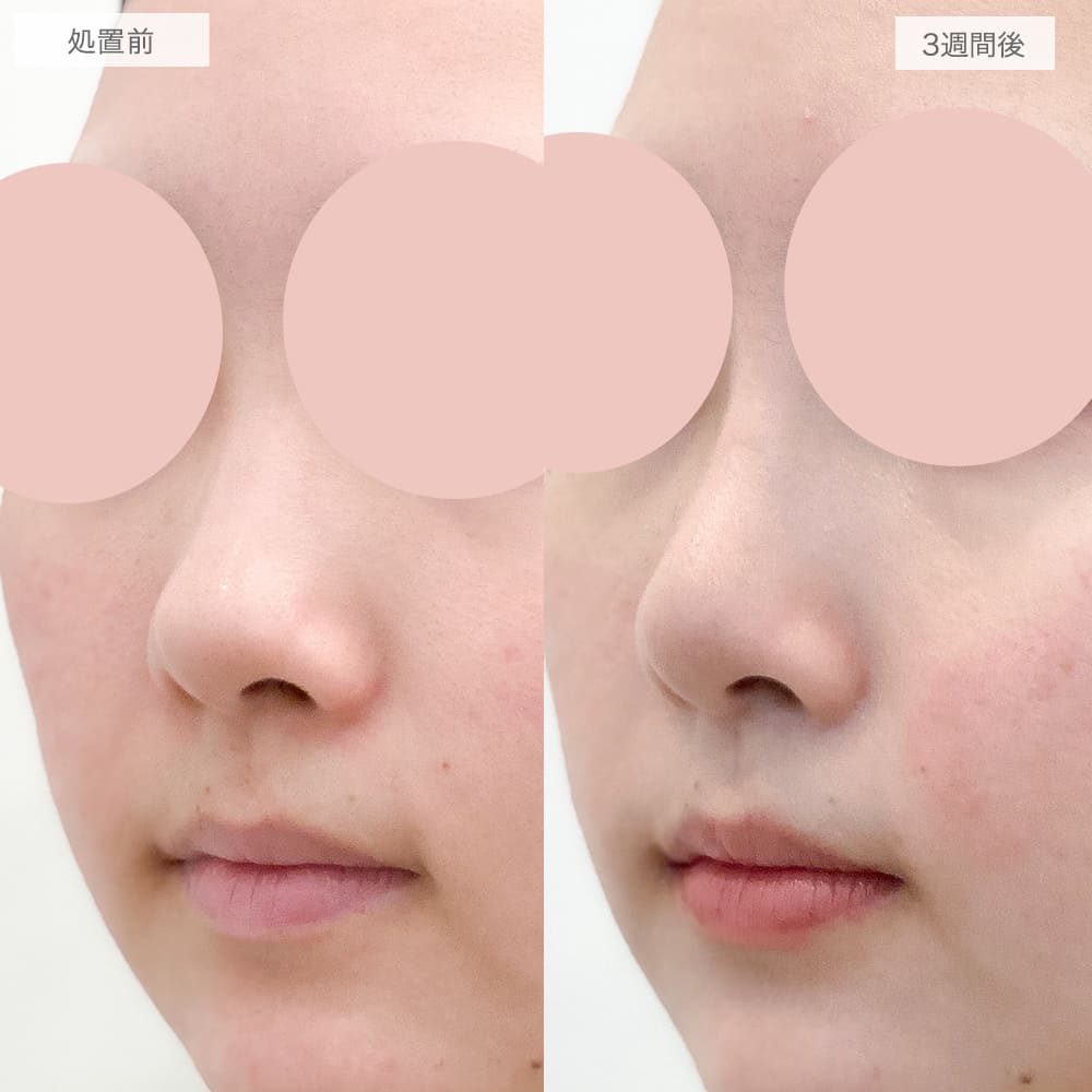 鼻プロテーゼ(隆鼻術)の症例写真