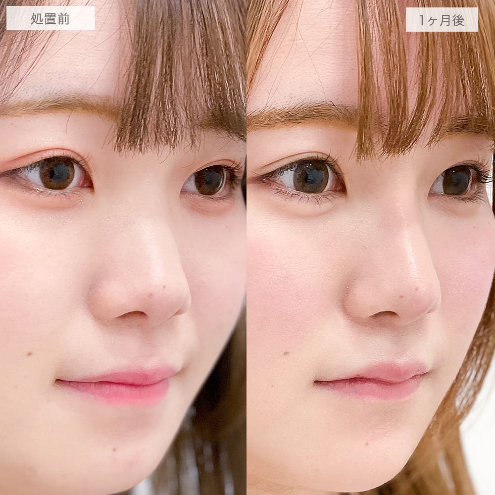 鼻プロテーゼ(隆鼻術)の症例写真