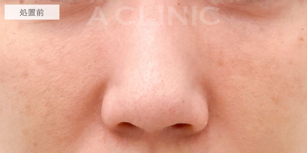鼻先縮小術切開法の症例写真5