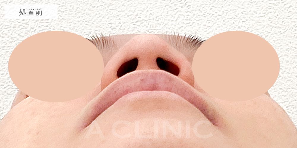 鼻先縮小術切開法の症例写真8