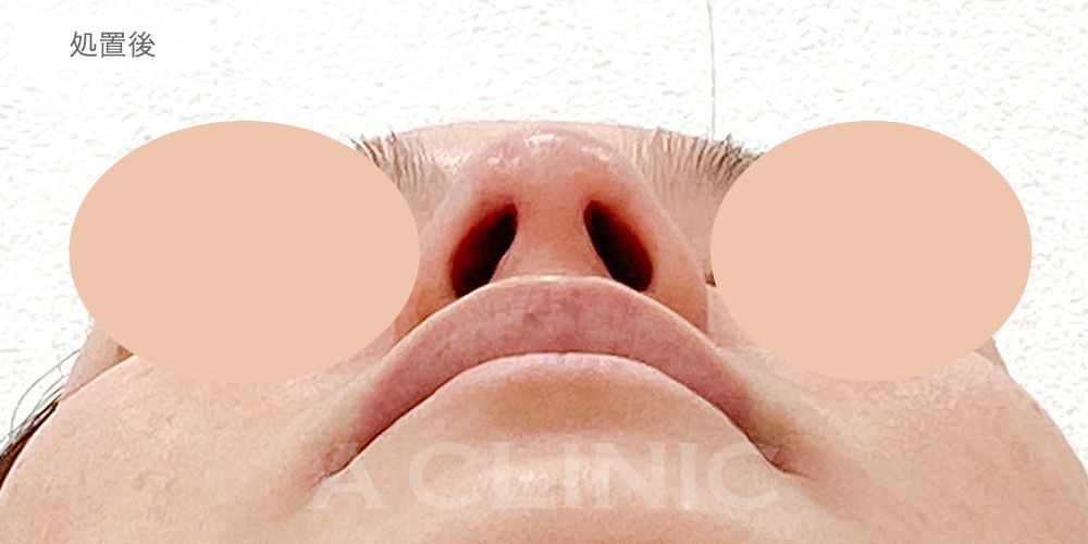鼻先縮小術切開法の症例写真9