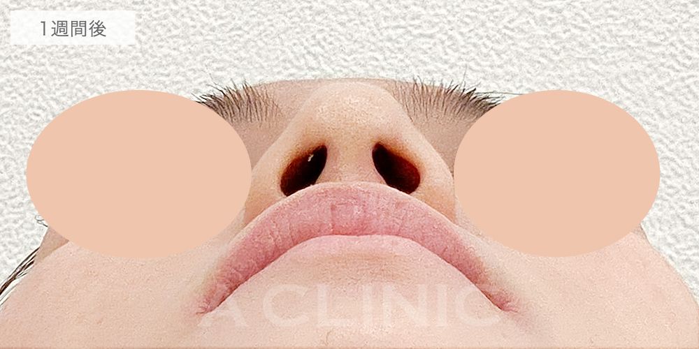 鼻先縮小術切開法の症例写真10