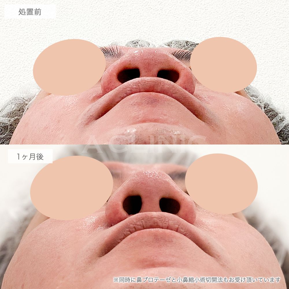 鼻先縮小術切開法症例写真1