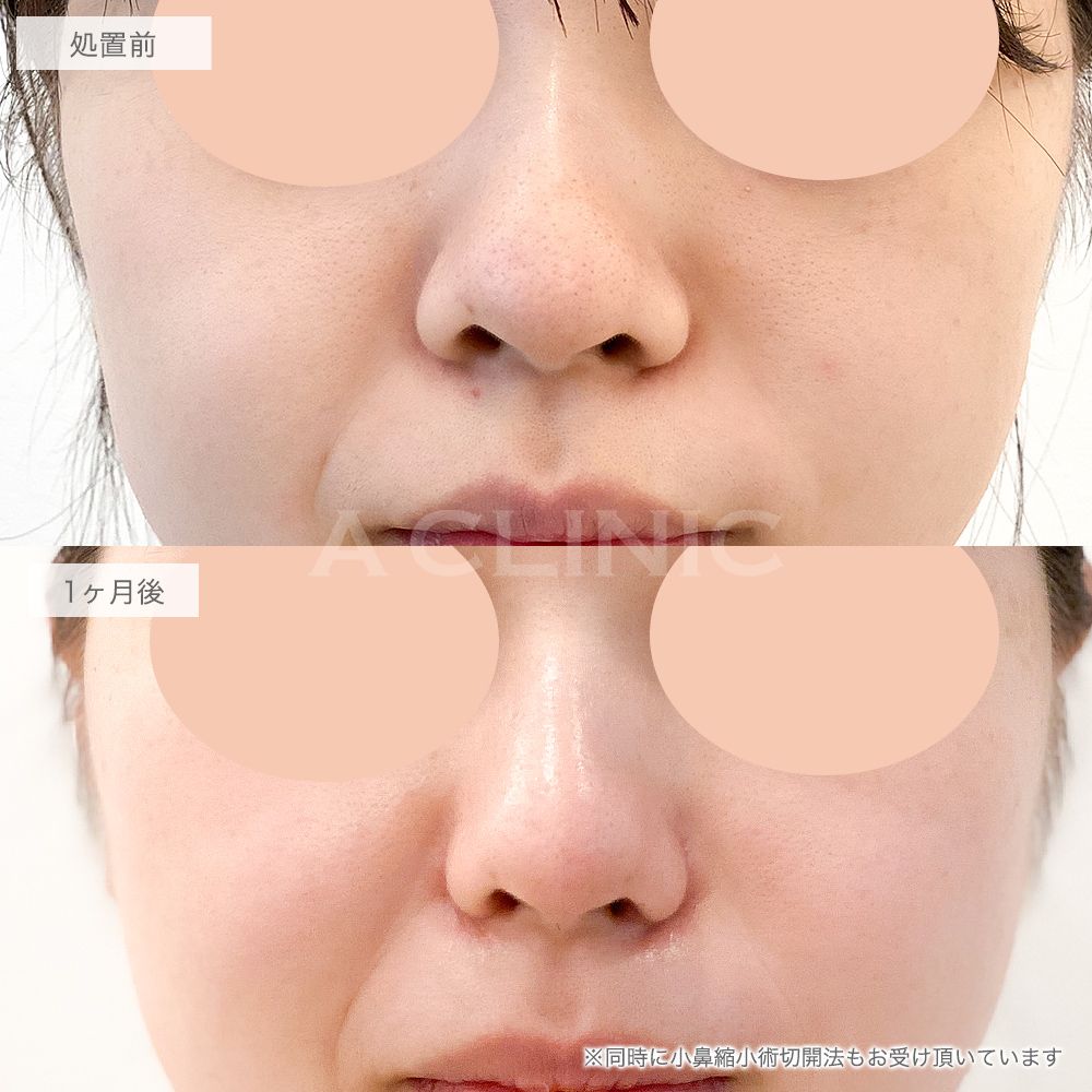鼻先縮小術切開法症例写真2