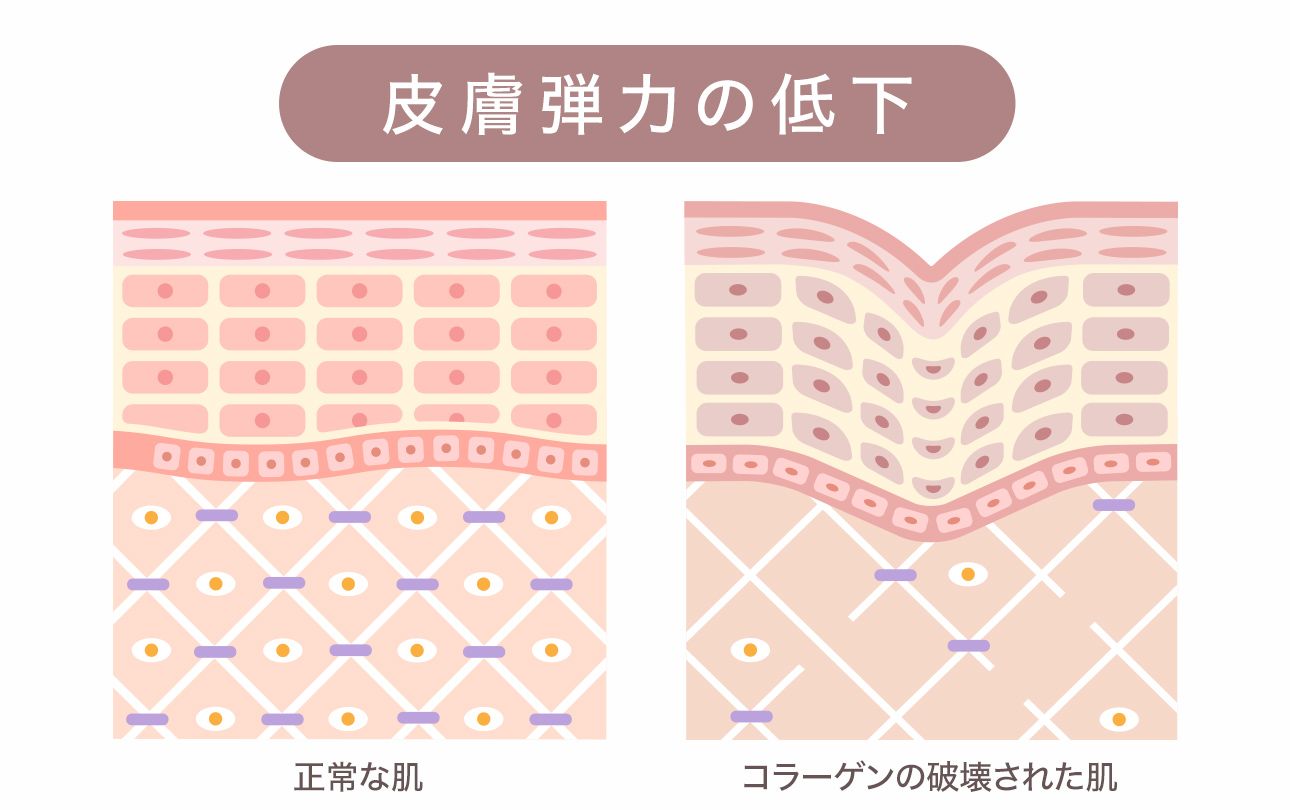 たるみの原因