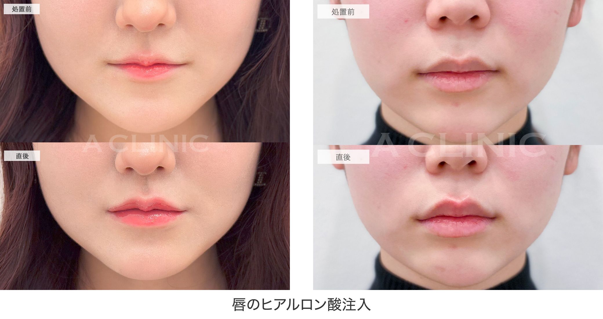 ヒアルロン酸唇の症例