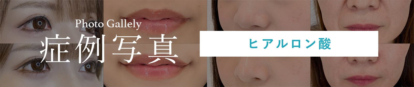 ヒアルロン酸症例写真