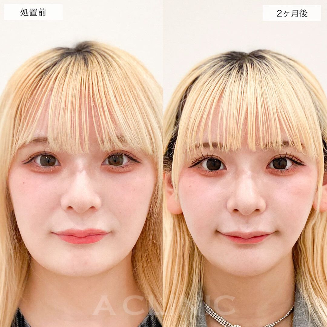 1day小顔脂肪吸引