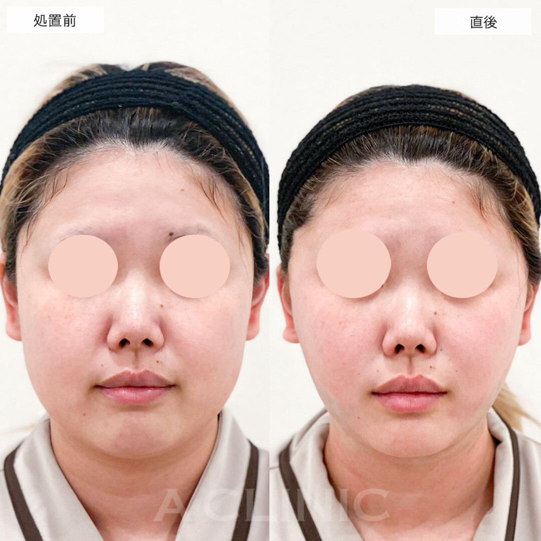 1day小顔脂肪吸引