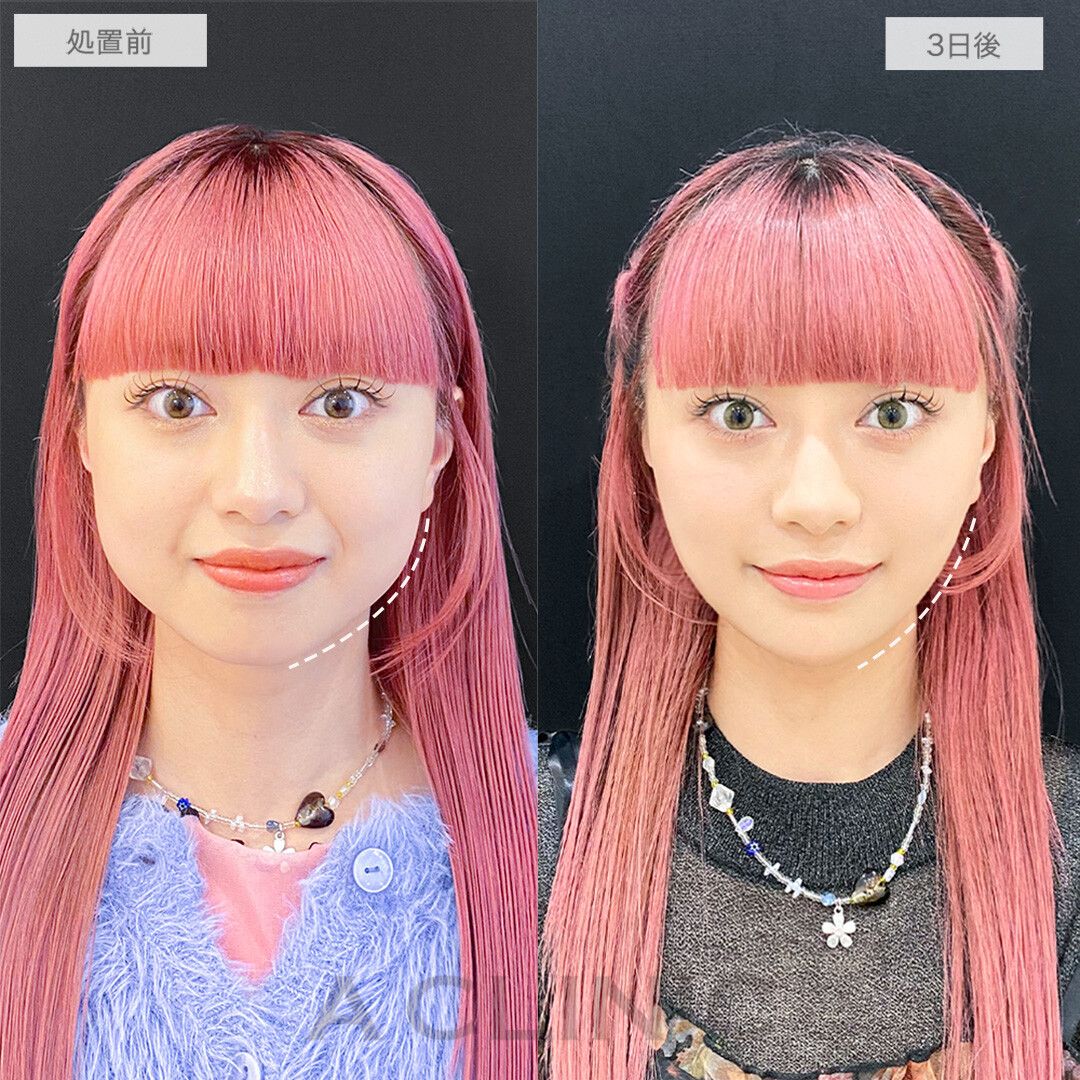 1day小顔脂肪吸引