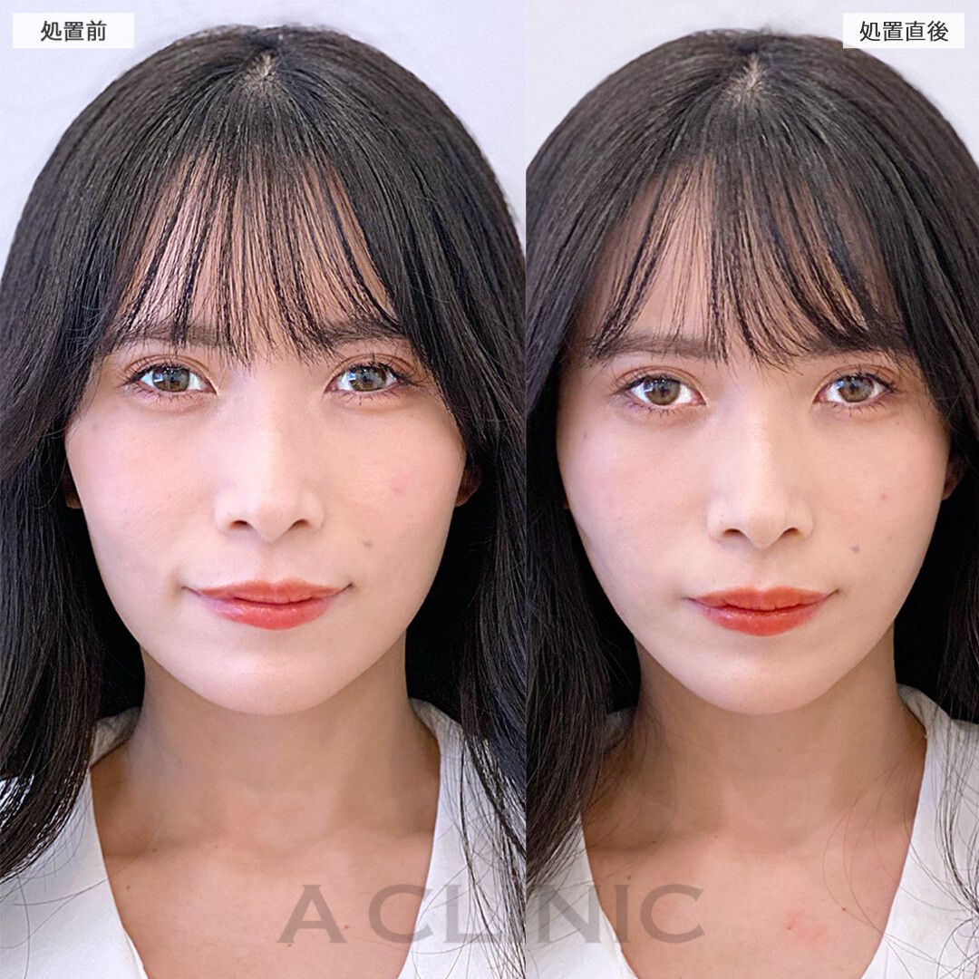 Aスレッド
