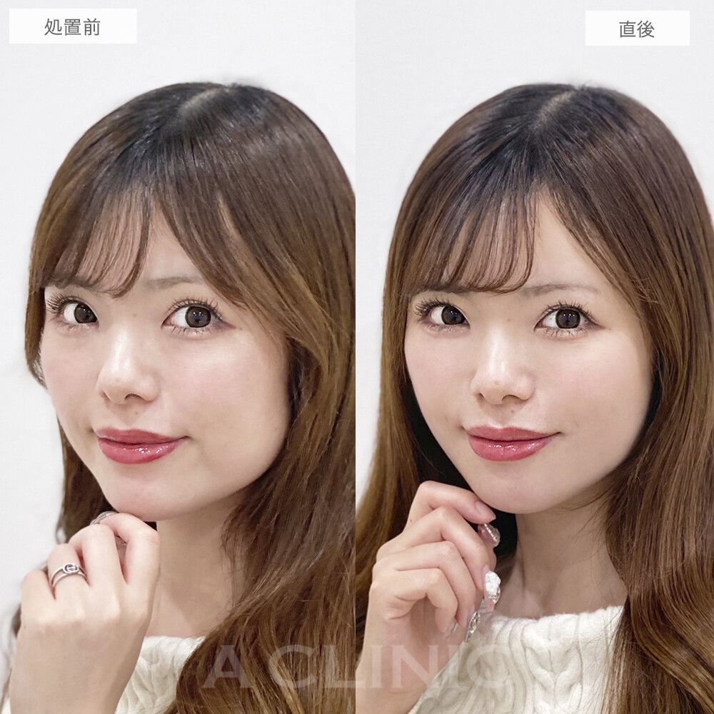1day小顔脂肪吸引