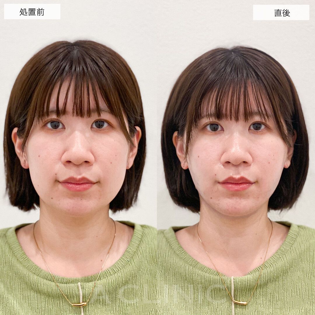 1day小顔脂肪吸引
