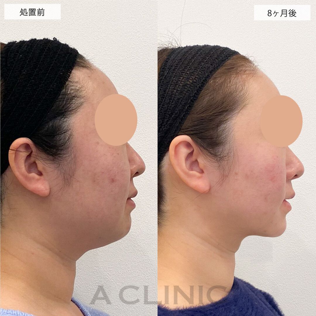 1day小顔脂肪吸引モニター