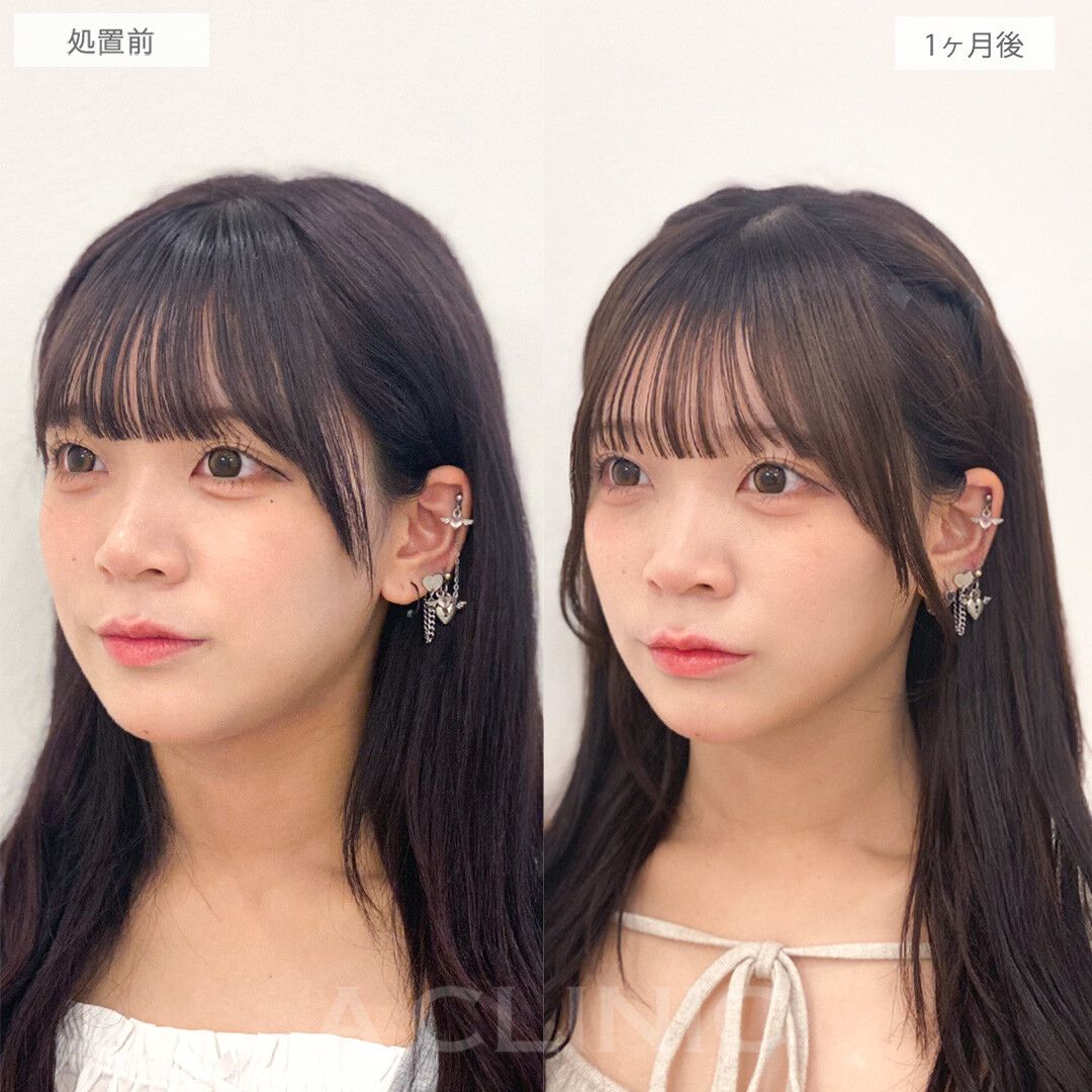 1day小顔脂肪吸引