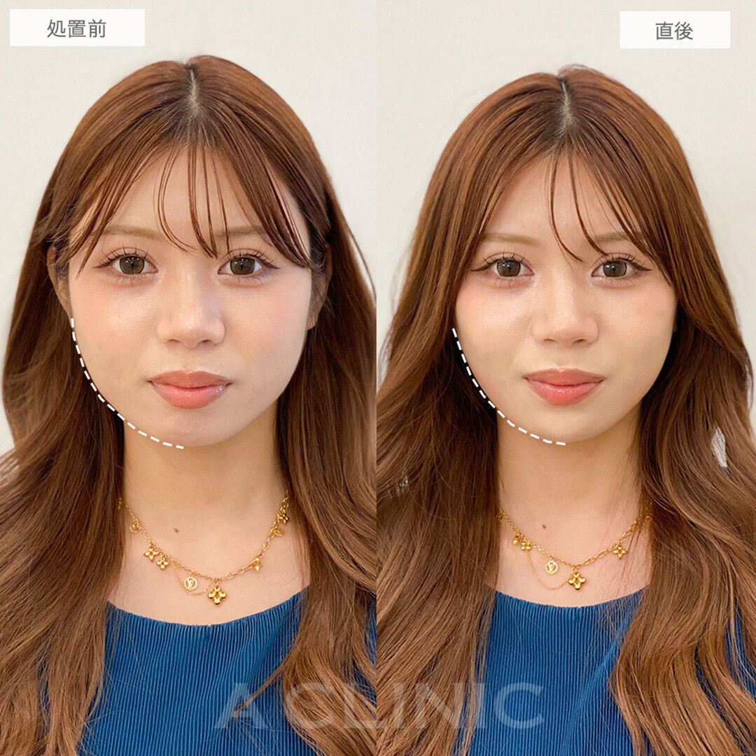 Aスレッド
