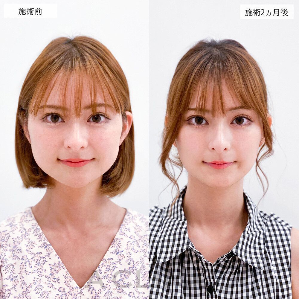 1day小顔®︎脂肪吸引