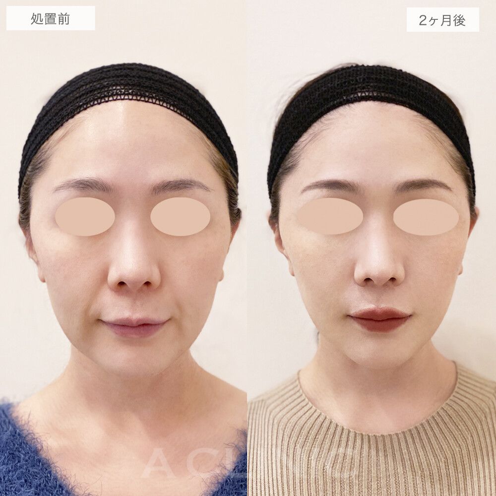 A式美肌たるみ切開