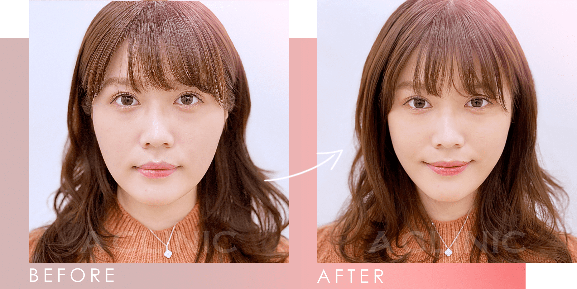 Aスレッドビフォーアフター