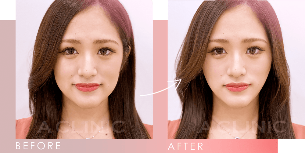 Aスレッドビフォーアフター