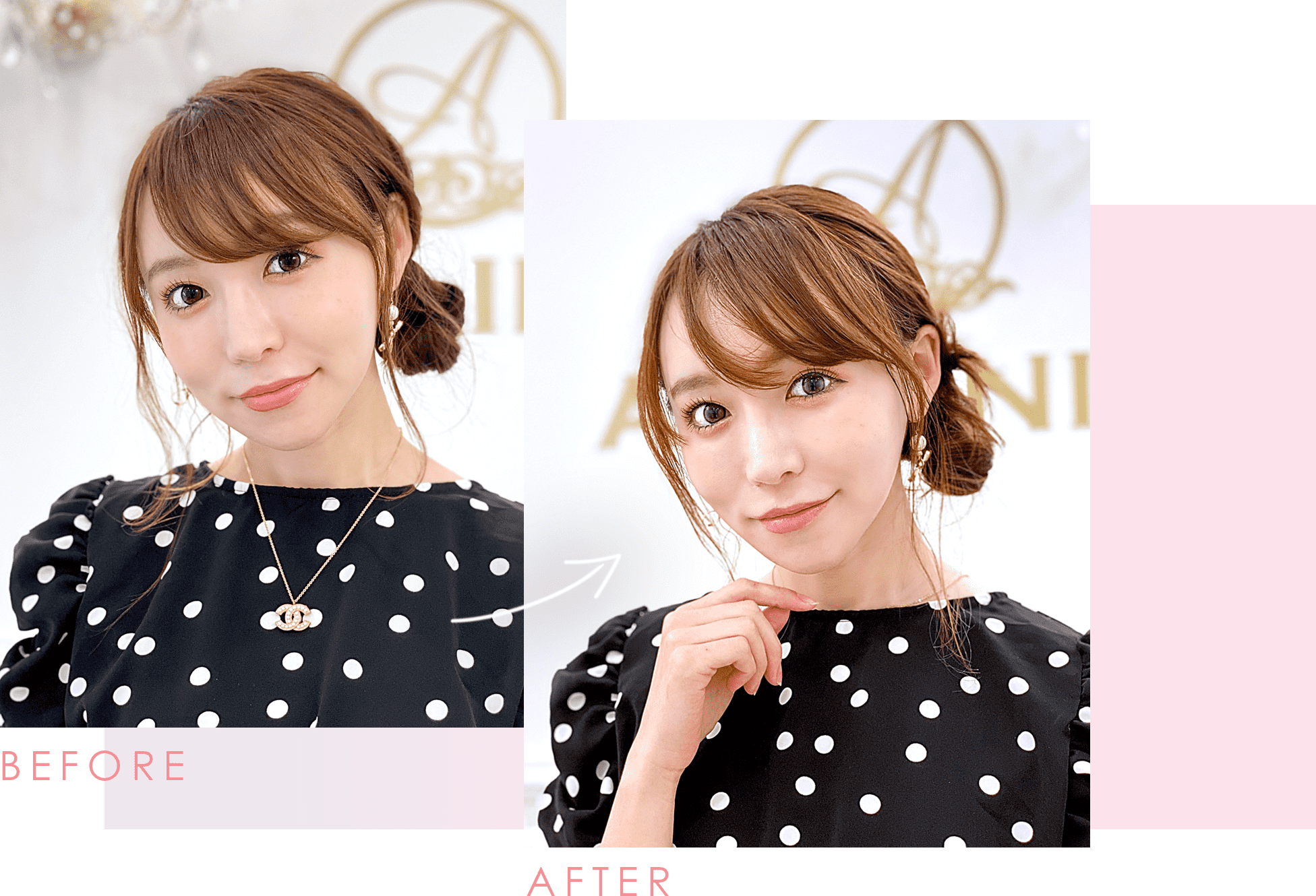 Aスレッド症例写真 ビフォーアフター