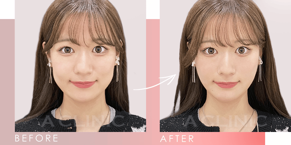 Aスレッドビフォーアフター