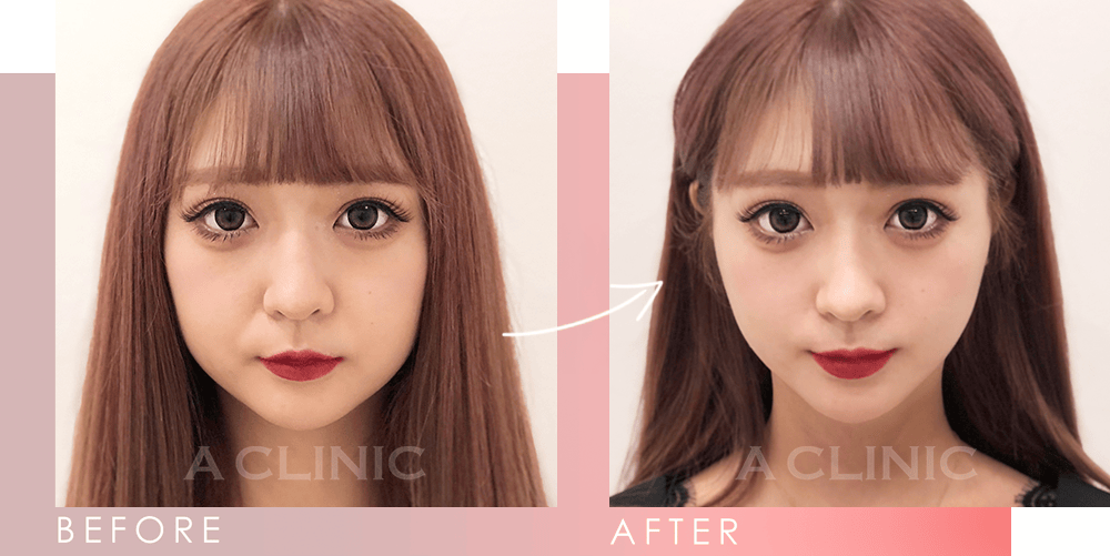 Aスレッドビフォーアフター