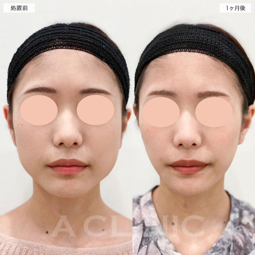 小顔ボトックスの症例写真