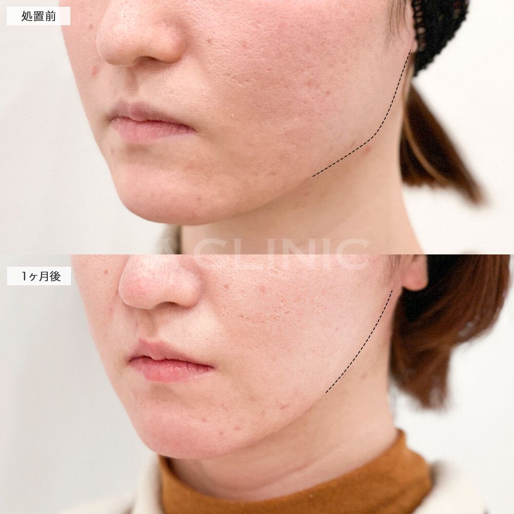 小顔ボトックスの症例写真