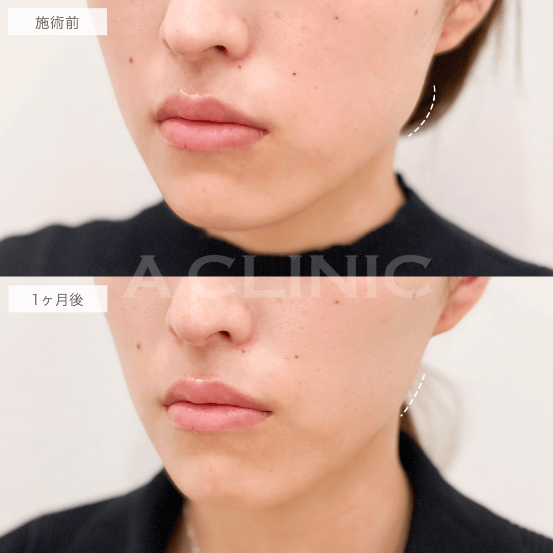 小顔ボトックスの症例写真
