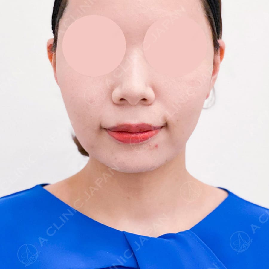 顔の横幅縮小術(脂肪吸引)after