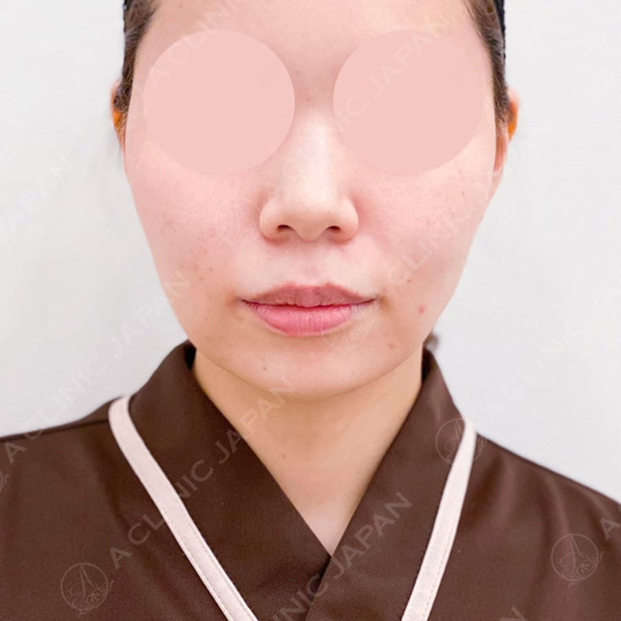 顔の横幅縮小術(脂肪吸引)before