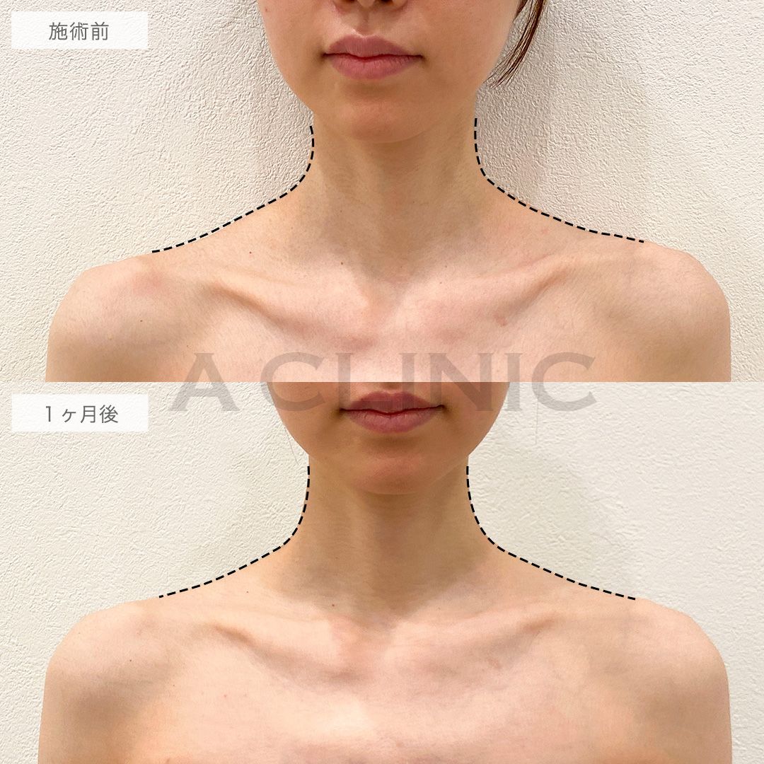 ボトックス注射の症例写真